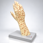Small Pox Pustules Model
